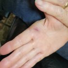 A hand with a small pinch mark.