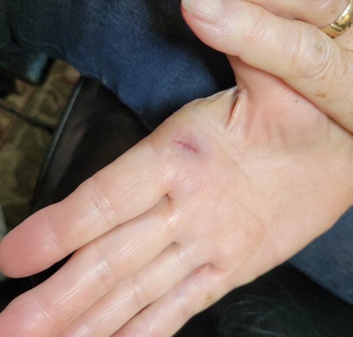 A hand with a small pinch mark.